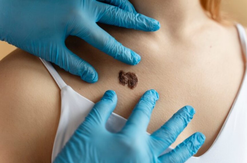 Researchers at Australia&rsquo;s QIMR Berghofer Medical Research Institute have unveiled a first-of-its-kind, free, online melanoma risk assessment tool aimed at estimating a person&rsquo;s chances of developing melanoma over 10 years. The innovation, which draws on a decade of data from more than 40,000 participants, represents a major step toward personalising early detection and intervention.

A Smarter Way to Predict Melanoma

This newly launched tool calculates risk by evaluating multiple scientifically established factors, such as:


	Sunburn history
	Family history of melanoma
	How an individual&rsquo;s skin reacts to sun exposure
	Geographic location (i.e. UV exposure where one lives)
	Number of moles
	Also included are smoking history and height


The online questionnaire takes only a few minutes to complete and returns a personalised risk profile. One of its key aims is to help direct clinical attention to those at higher risk &mdash; while reducing needless screening for lower-risk people. As Professor David Whiteman explained:

&ldquo;Our health system is at capacity &hellip; we want to make sure people who need skin checks are being checked &hellip; but not necessarily needing regular skin checks.&rdquo;

Still, the researchers caution that the tool is not foolproof:

&ldquo;Even if the tool tells you you are low risk, you still might have a melanoma, so it&rsquo;s not to be complacent.&rdquo;

The risk estimator is publicly accessible at qimrb.edu.au/melanoma.

Why It Matters

Melanoma remains one of Australia&rsquo;s most common and dangerous cancers. Early detection typically leads to simpler treatment, better outcomes, and reduced costs. By stratifying individuals by risk, this tool may help:


	Focus limited dermatological resources on those who need them most
	Encourage lower-risk individuals to practice sun protection and self-monitoring
	Reduce strain on health services by cutting down low-yield screening


However, for patients who do require treatment &mdash; especially those needing surgery or other interventions &mdash; early detection is only one piece of the puzzle. The next question is: How can we support patients during hospital stays and treatment periods?

Supporting Patients Through Hospital Stays: Accommodation and Aid

When patients must travel for specialised care or stay near a hospital for treatment, the issue of accommodation becomes crucial. Some hospitals and regions offer dedicated lodging or subsidised support; others rely on external organisations. Below are examples and models in Australia that help bridge this gap.

Accommodation &amp; Support Models in Australia


	Red Cross Medical Accommodation
	In Queensland, the Red Cross maintains low-cost lodging centres adjacent to hospitals, such as the Cairns Wellbeing Centre, Townsville Wellbeing Centre, and Mackay Accommodation Centre. These facilities provide safe, affordable rooms for patients and their families while receiving treatment. If eligible under the Patient Travel Subsidy Scheme (PTSS), there may be no out-of-pocket cost.
	Patient Travel Subsidy Scheme (PTSS)
	In Queensland, PTSS offers financial support for both travel and accommodation for patients who need to travel to access specialist services not available locally.
	Isolated Patients Travel and Accommodation Assistance Scheme (IPTAAS)
	In New South Wales, IPTAAS provides assistance with accommodation costs (and travel) when patients travel more than 100 km for specialist medical care.
	Hospital-affiliated visitor lodging
	Some hospitals offer basic shared accommodations for patients&rsquo; families and carers. For example, St Vincent&rsquo;s Hospital Sydney provides a shared facility (shared bathrooms, basic kitchen/laundry) at a rate of AUD 30 per person per night.
	Hospital Stays Directory &amp; Patient Hotels
	Platforms like Hospital Stays list apartments and hotels close to medical facilities to ease logistical burdens.
	Also, &ldquo;patient hotels&rdquo; (lodging facilities close to hospitals for those who don&rsquo;t need intensive care) serve as an intermediate accommodation option, freeing up hospital beds for those in critical condition.
	In-hospital bedside or parent accommodations
	Hospitals sometimes allow a caregiver or family member to stay in a room with or adjacent to the patient. For example, Perth Children&rsquo;s Hospital offers &ldquo;bedside accommodation&rdquo; (day beds in patient rooms) and works with Ronald McDonald House for families living more than 100 km away. P
	Dormitory for attendants (India example)
	In India, a cardiovascular hospital in Mysuru is constructing an 80-bed dormitory on campus to provide basic lodging for patient attendants, many of whom previously slept in corridors or open spaces.


These models illustrate that when hospitals and support services collaborate, patient care becomes more accessible, less stressful, and more humane.

The Bigger Picture

The development of a risk-prediction tool for melanoma is a highly promising development &mdash; it aims to catch skin cancer earlier and more efficiently. But the clinical journey doesn&rsquo;t end there. Once a patient is flagged for treatment, ensuring they have reliable lodging, financial support, and emotional resources is vital.

In many places, these support structures already exist; in others, they must be developed. As predictive medicine advances, so too must the systems that help patients traverse treatment pathways &mdash; including the often-overlooked but essential component of hospital stay accommodation.
