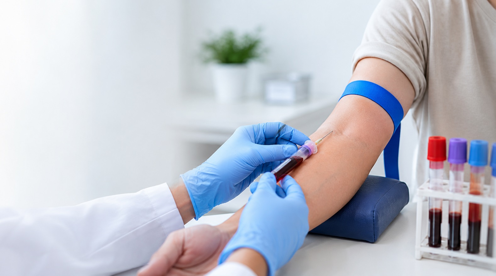 Thousands of former patients of a retired Sydney dentist have been advised to undergo precautionary testing for hepatitis B, hepatitis C, and HIV following concerns about infection control practices at his clinic. The public health alert has understandably caused concern among patients and their families, particularly those who may have received dental treatment at the practice many years ago.

NSW Health issued the alert on 13 May 2026 for all patients who had been treated by Dr William Tam at Suite B, 2 Albert Road, Strathfield, in Sydney&rsquo;s inner west. Although authorities have assessed the overall risk of infection as low, former patients have been encouraged to speak with their general practitioner or another healthcare provider and arrange blood tests as a precaution.

Concerns Identified During an Audit

The warning followed a recent audit of the dental premises by the Dental Council of NSW. The audit identified concerns relating to infection control procedures and the way patient records had been maintained. Poor record-keeping has made it difficult for health authorities to identify and directly contact every person who may have attended the practice.

Dr Tam reportedly practised at the Strathfield clinic for more than 25 years before retiring and is no longer registered as a dentist. Because of the length of time the clinic operated and the limited patient records available, NSW Health has issued a broad public appeal rather than contacting only a specific group of former patients.

The alert does not mean that patients have contracted a blood-borne virus. Instead, it reflects a precautionary public health response designed to identify any possible infections early and provide treatment where necessary.

Why Infection Control Is Important in Dentistry

Dental procedures often involve contact with saliva, blood, gums, tooth roots, and other tissues. Instruments must therefore be thoroughly cleaned, disinfected, and sterilised between patients in accordance with professional infection control standards.

When equipment is not properly sterilised, there is a potential risk that blood-borne viruses could be transmitted between patients. Procedures involving needles, bleeding, broken skin, or treatment below the gum line may present a greater risk than routine examinations, although NSW Health has stressed that the assessed risk in this case remains low.

Strict infection control is a central part of safe dental care. It protects patients, dentists, dental assistants, and other staff from preventable exposure to infectious diseases.

Understanding Hepatitis B, Hepatitis C, and HIV

Hepatitis B and hepatitis C are viral infections that primarily affect the liver. Without appropriate monitoring or treatment, they may lead to long-term liver damage and other serious complications.

HIV affects the immune system and can make it harder for the body to fight certain illnesses. However, significant advances in medical treatment mean that people diagnosed with HIV can manage the condition effectively and live long, healthy lives.

One reason testing is so important is that people with hepatitis B, hepatitis C, or HIV may not experience noticeable symptoms for many years. A person may feel completely healthy while still carrying an infection. NSW Health has advised that effective treatments are available for all three conditions, making early detection particularly valuable.

What Former Patients Should Do

Anyone who received dental care from Dr William Tam at the Strathfield practice should contact their GP or healthcare provider and request testing for hepatitis B, hepatitis C, and HIV. This advice applies even when the dental treatment took place many years ago.

Patients should explain that they attended the affected practice and are responding to the NSW Health public alert. Their doctor can discuss the appropriate blood tests, review their vaccination history, and provide individual medical advice.

People should not assume they are infected or delay seeking advice because they feel well. The recommendation to test is precautionary, and the likelihood of infection has been described as low. Testing can provide reassurance and, in the event that an infection is detected, allow treatment and follow-up care to begin promptly.

Planning for Testing and Medical Appointments

Some former patients may need to travel into Sydney for medical consultations, specialist appointments, testing, or follow-up care. For patients travelling from regional areas, arranging comfortable hospital accommodation in Sydney may help reduce the pressure of repeated journeys. Staying close to a hospital or medical centre can provide patients and accompanying family members with a practical base, particularly when several appointments are scheduled over consecutive days.

Furnished accommodation with a kitchen, laundry facilities, and separate living space may also offer greater comfort for older patients, caregivers, and families who need to remain near medical services for an extended period.

Avoiding Fear and Misinformation

Public health alerts involving HIV and hepatitis can cause anxiety, but it is important to rely on information from NSW Health and qualified healthcare professionals rather than social media speculation. The alert is not confirmation of widespread infection, and no patient should be blamed or stigmatised for seeking testing.

The most appropriate response is to remain calm, arrange the recommended tests, and discuss any concerns confidentially with a healthcare provider. Former patients requiring further information can also contact Healthdirect on 1800 022 222.

A Reminder About Patient Safety

The Strathfield dental alert demonstrates why strong infection control systems, accurate patient records, regular audits, and professional accountability are essential in healthcare settings.

For affected patients, the key message is straightforward: the assessed risk is low, but precautionary testing is recommended. By seeking medical advice promptly, patients can receive reassurance, access effective treatment if required, and protect their long-term health.
