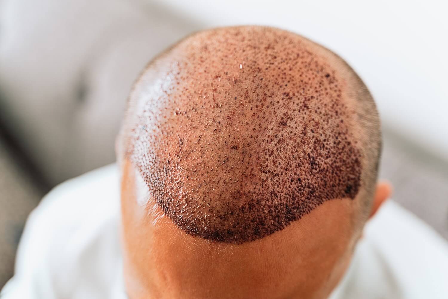 hair transplant for aussies